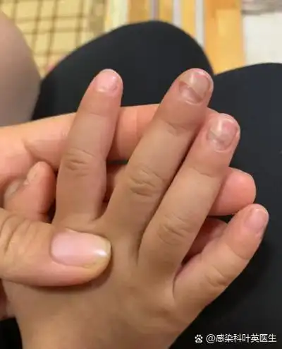 手足口病痊愈后出现指甲脱落是常见现象