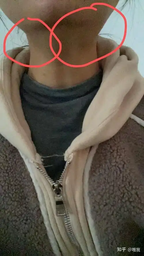 颌下腺肿大 - 知乎