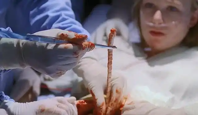 女孩经常头疼,医生一检查,肚子里长了一条寄生虫