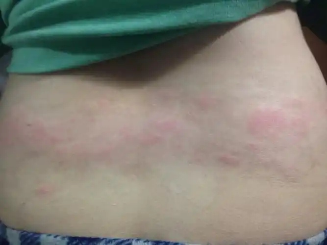 问:怀孕12周,腰部突然起了很多疙瘩.很痒.