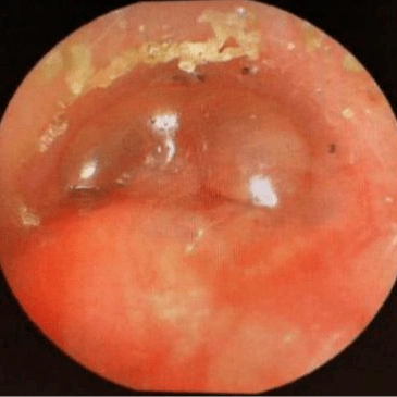 听到大疱就腿软揭秘鼓膜承受的痛