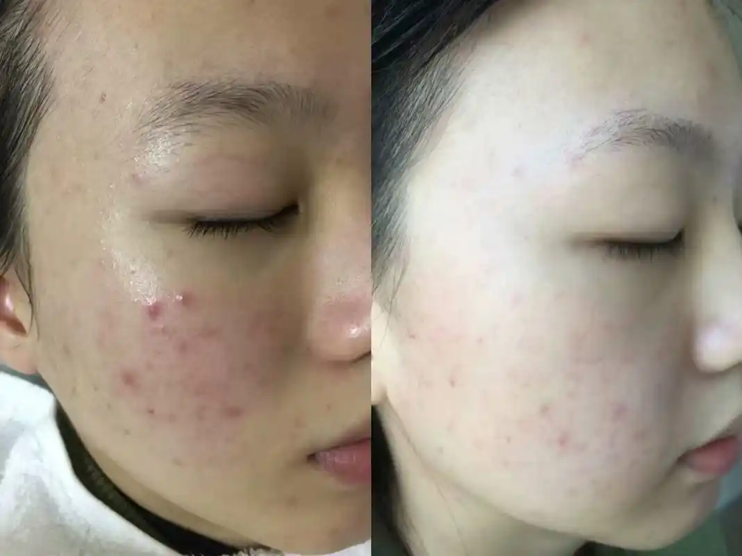 喷雾仪对面部进行深层清洁;3,在喷雾仪做热喷的同时对皮肤进行痘痘