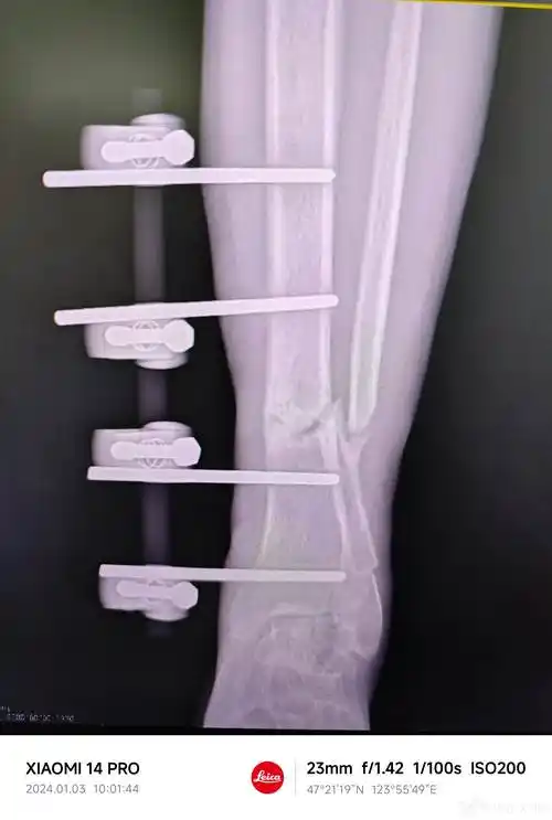 胫腓骨远端骨折外固定架