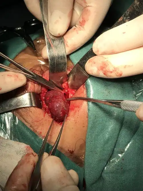 眼眶内肿瘤切除术医者版