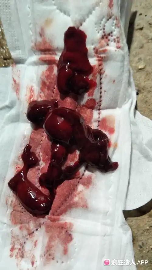 12周 昨晚肚子疼流血块了