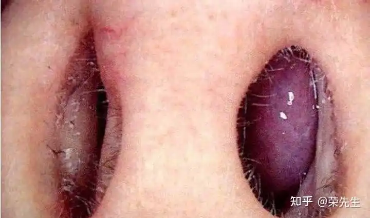 1,通常会出现喷嚏,鼻塞,鼻痒等症状,可伴有眼痒,结膜充血等眼部症状.