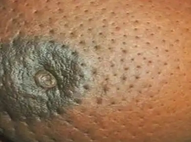 乳房病变之不对称