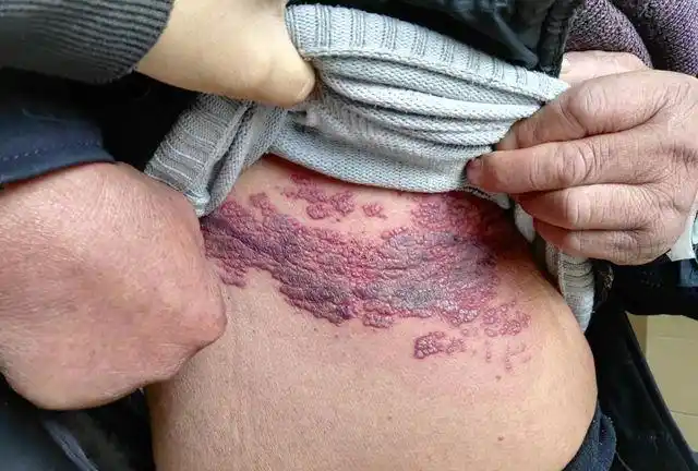 蛇盘疮腰缠一圈真的会要人命吗(缠腰龙蛇盘疮)