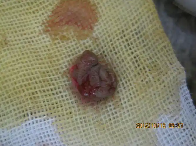 肛裂肛肥大哨兵痔王女士20121018