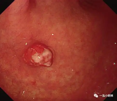 胃息肉及息肉综合征更新