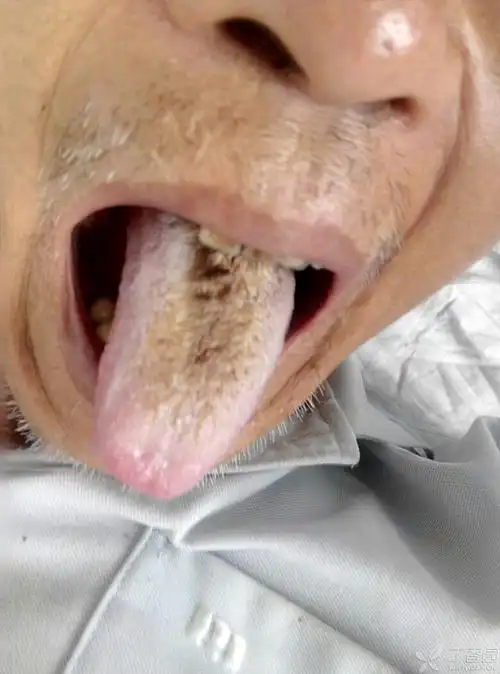 这样的舌苔是什么病. - 神经内外 -丁香园论坛