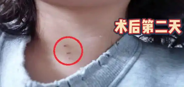 后患者与主刀医生合影超声引导下实行甲状腺结节射频消融术前咨询近日