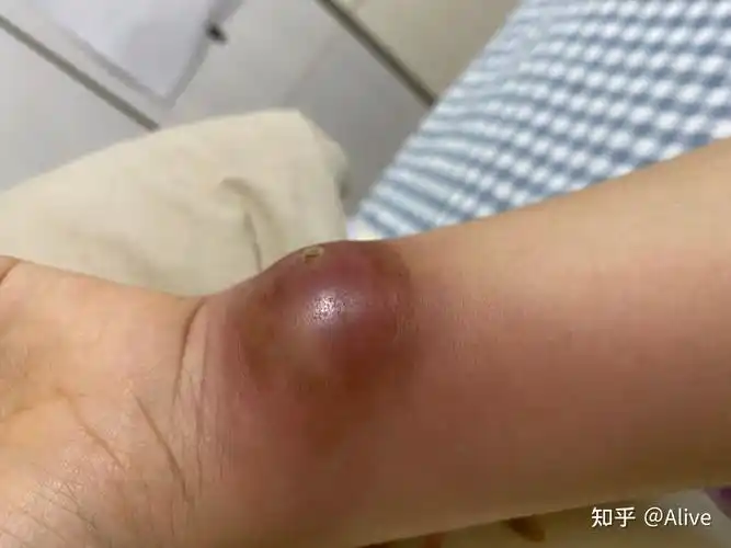 怀孕了还碰上火疖子剧痛无比,我这是什么体质(捂脸) - 知乎