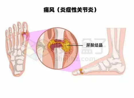 痛风炎症性关节炎人体脚骨解剖图尿酸结晶5543590矢量图片免抠素材