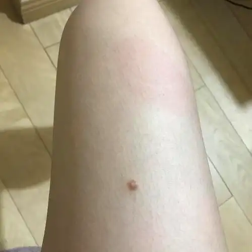 大腿上一颗痘痘请问这是纤维瘤嘛