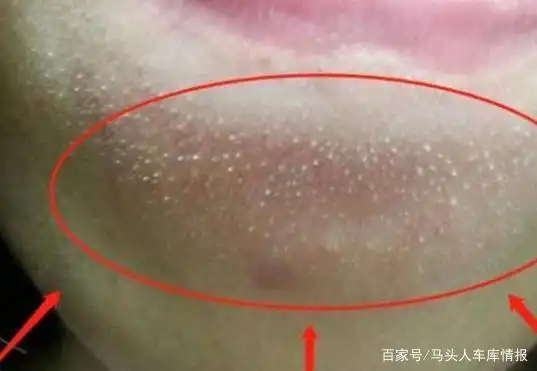 下巴密密麻麻全是白色颗粒?莫慌!只需3步,统统清除