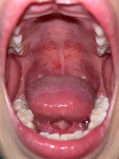 最近的流行病#疱疹性咽峡炎.