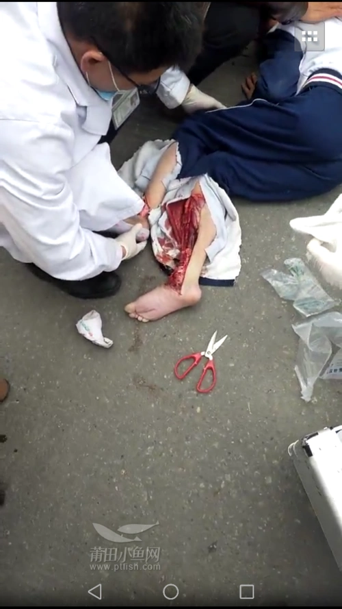 一条腿血肉模糊!