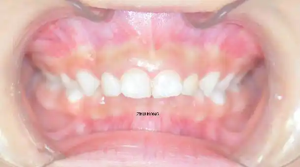 孩子4岁总是咬下嘴唇笑的时候门牙突还露牙龈怎么办