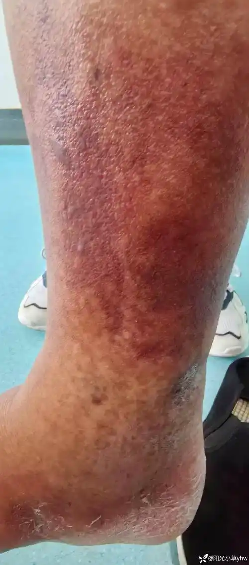 双下肢皮肤病1例