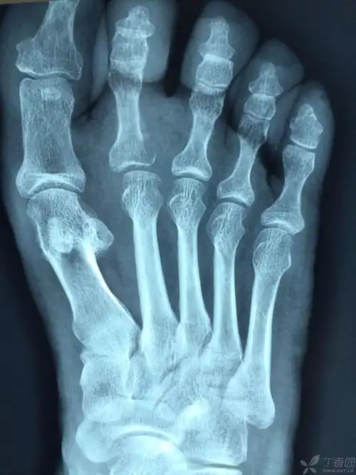 右足第二近节趾骨骨质破坏