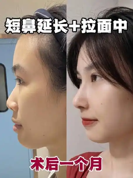 兮兮半肋鼻综合术后一个月对比