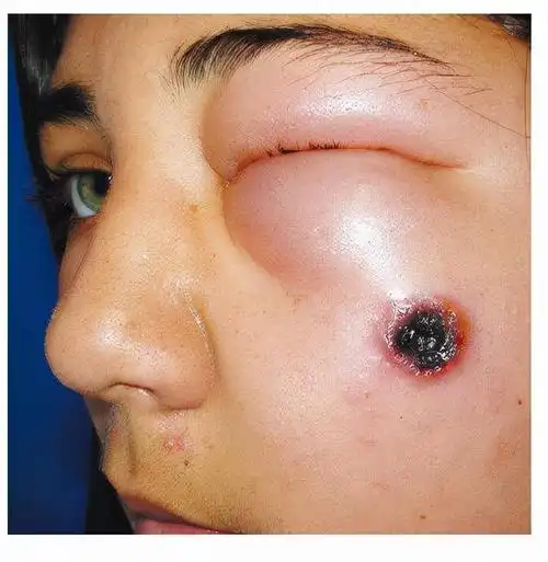 14岁学生感染10天后死亡,"炭疽病"到底是什么?这种肉不要碰