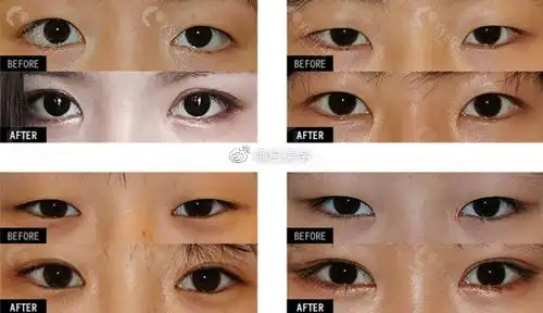 开眼角前后对比照