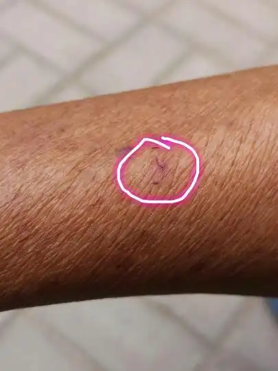 狗跳起来不小心牙划到皮肤了,用打狂犬疫苗么