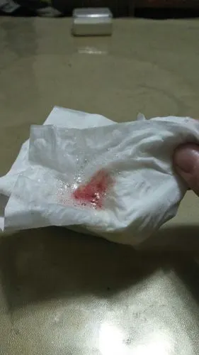 右边喉咙痛咳嗽,咳出来还有痰还有血丝,请问什么药可以调理好?