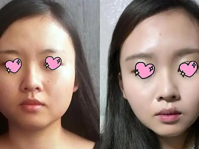 体验项目去颊脂垫去咬肌术后2个月