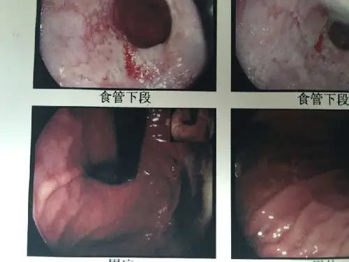 典型反流性食管炎内镜下表现