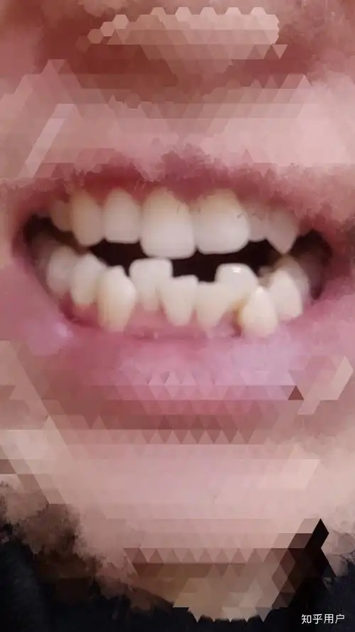 牙不齐(倾斜,拥挤)是怎样的体验?