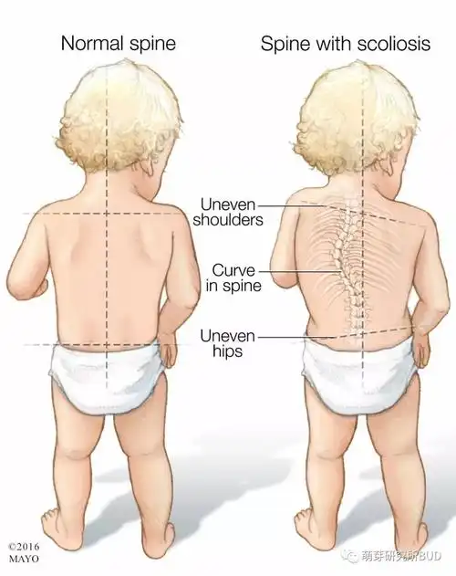 但有一种特发性脊柱侧弯,早期不易发觉.