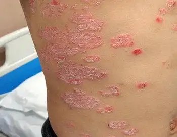 地图状牛皮藓症状