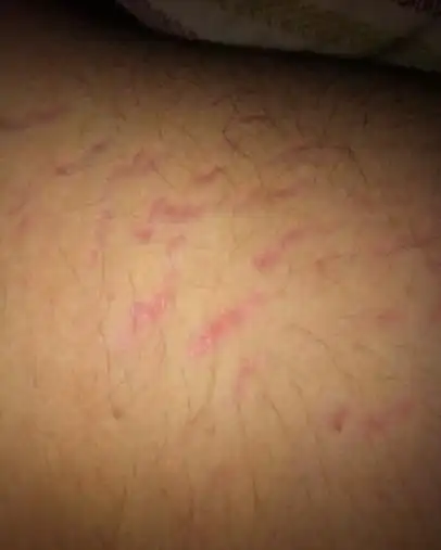 大腿上一条一条的紫红色纹 是怎么回事