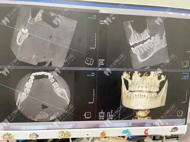 口腔全景片影像