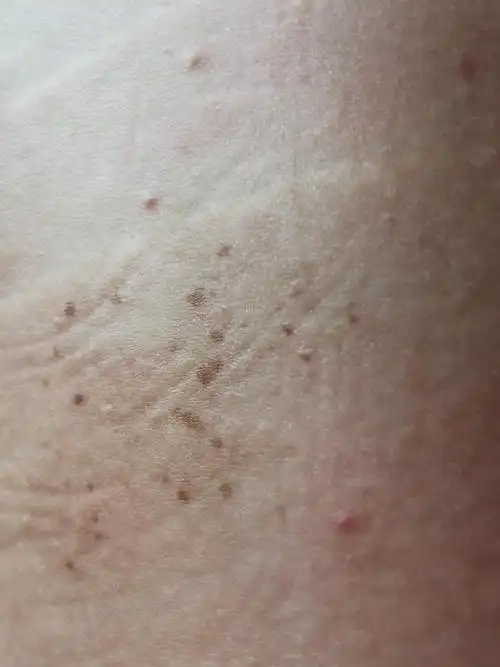 腰上有一小片这个东西