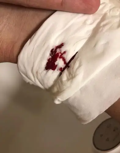 下午不小心被蚂蝗咬了,一直在流血!正常吗?已经用盐在处理伤口了