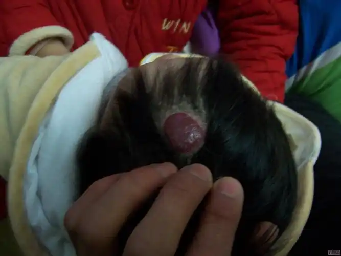 【求助】头上生血瘤?