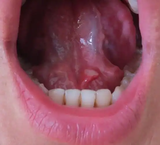 舌头下面长了个白斑,舌苔也泛白,这是怎么了?如何治疗?谢谢解答-见图