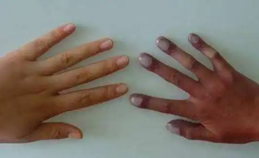 发绀有哪些疾病分类?