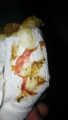 这样大便有几天了,前天做便常规正常,这个是什么原因呢?