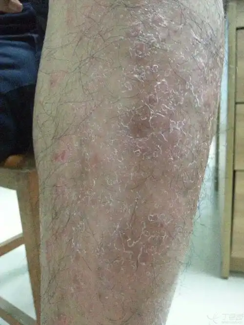 7,空腹据说10点多 初期小腿,在外院按银屑病处理,皮疹逐渐增多, 背部