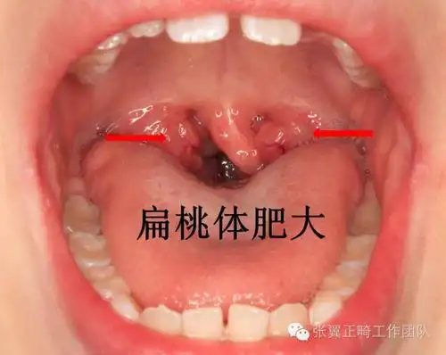 小孩有张口呼吸家长得警惕