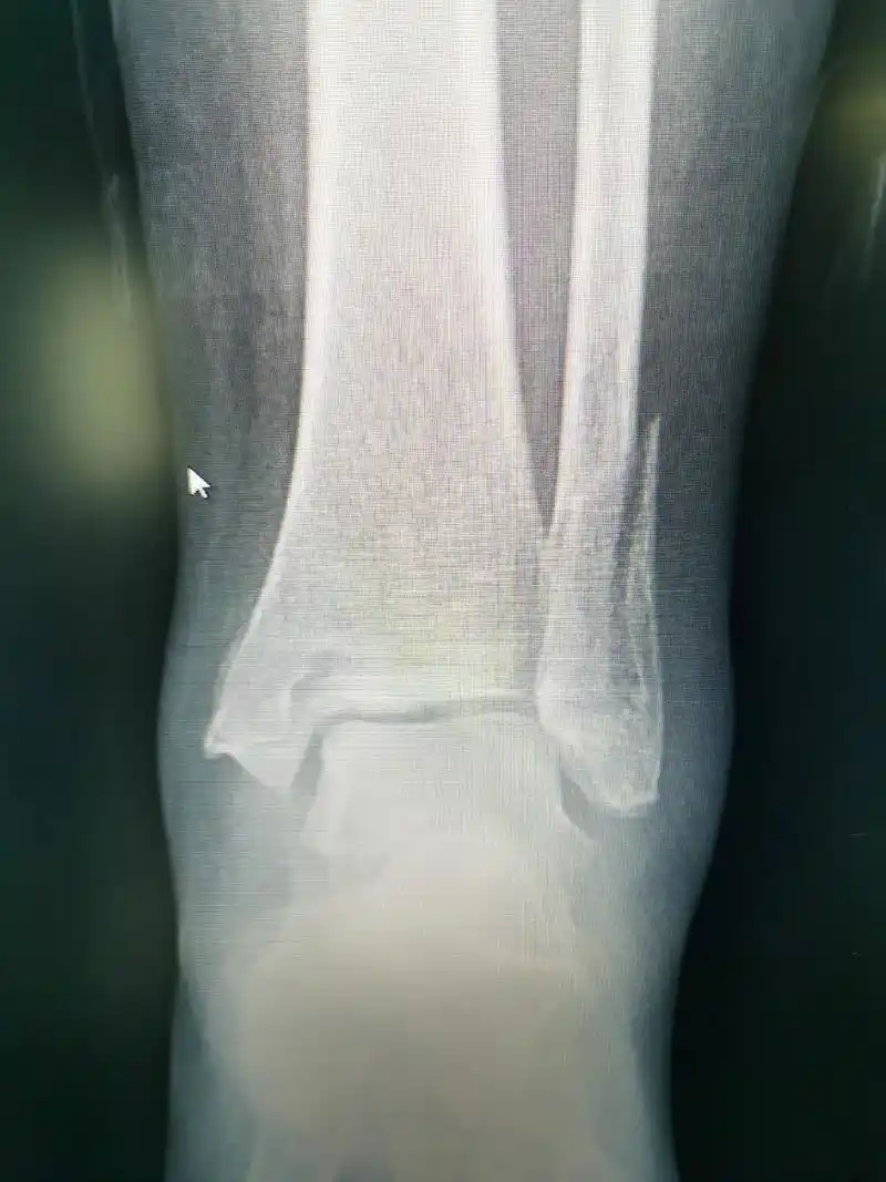 本例患者扭伤所致,踝关节 - 抖音