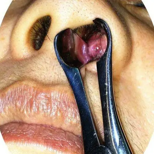 息肉的图片_有来医生