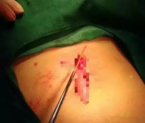 广西男子肚中取出5厘米牙签,都是这个习惯害了他!