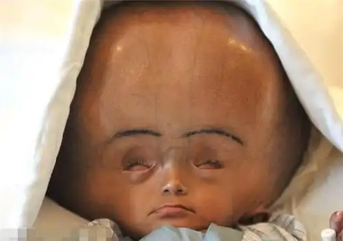 印度大头娃娃患脑积水头是正常人的三倍大