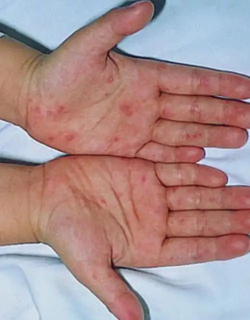 梅毒_梅毒能治愈吗_列宁梅毒